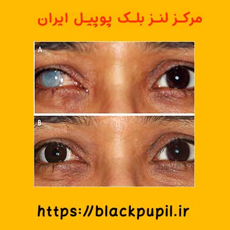 کاربرد لنزهای بلک پوپیل