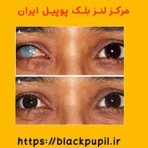 قیمت لنز بلک پوپیل