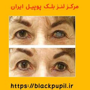 لنز بلک پوپیل